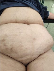 przepuklina brzuszna,przepuklina pooperacyjna,przepuchlina,operacja przepukliny