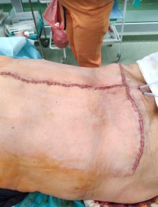 przepuklina brzuszna,przepuklina pooperacyjna,przepuchlina,operacja przepukliny